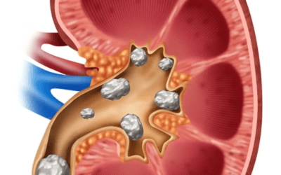 Kidney stones